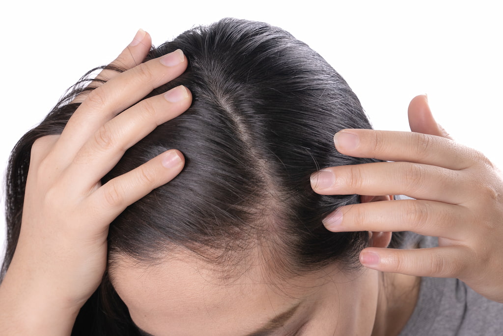 CAN LICE CAUSE HAIR LOSS? LiceDoctors